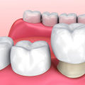 What Kind of Dentist is Best for Crowns?