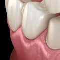 What Type of Dentist is Best for Crowns?